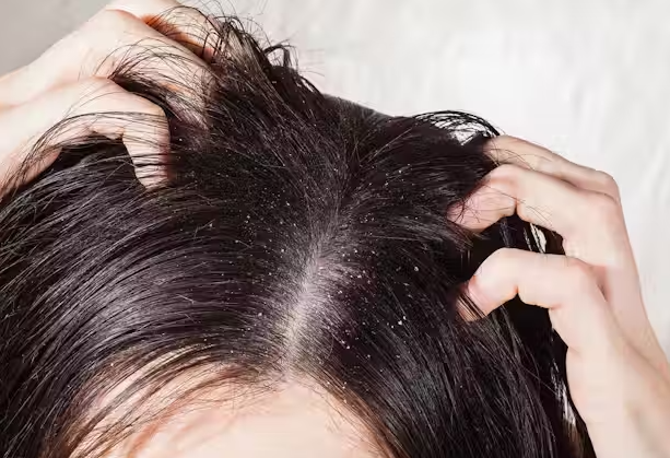 비듬의 원인과 치료 방법 표지